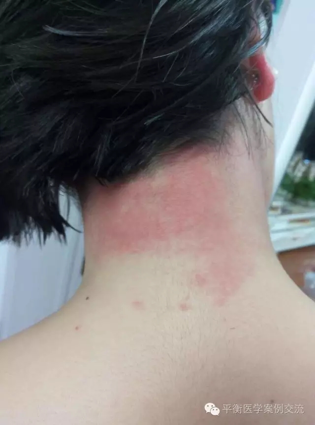 调理前脖子过敏起成片疙瘩,耳朵周围红肿发根疙瘩成片,痒的无法睡觉