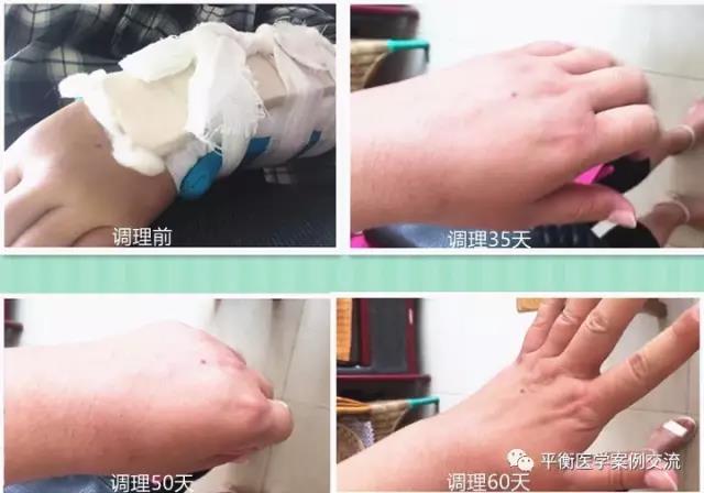 左手腕部粉碎性骨折,用佑三10天快速消肿,60天活动自由