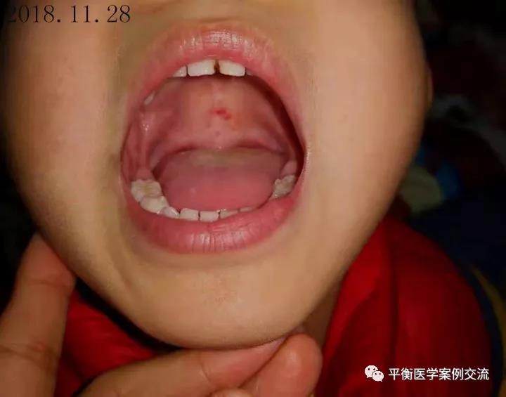 11月27日,由于口腔炎症上颚大片冲血,严重影响了日常进食.