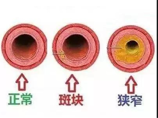 颈动脉人体最怕堵的血管50中风都跟它有关