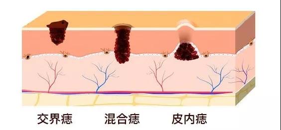 痣要恶变的8个信号医生教你一眼辨别