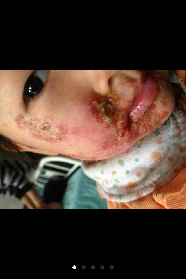 佑三软膏调理脓包疮效果对比